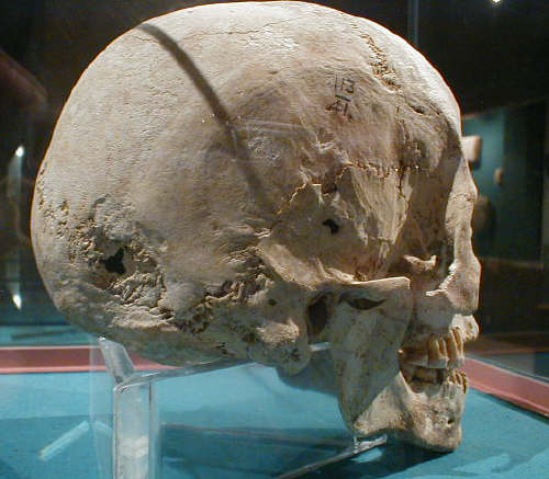 Skull with an artifical deformation